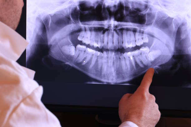 Best Knocked-Out Tooth (Avulsed Tooth) Treatment in West Falls Church, VA