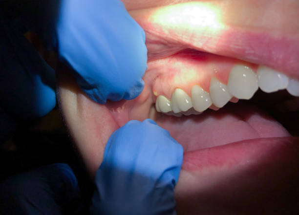 Best Emergency Care for Gum Disease in West Falls Church, VA